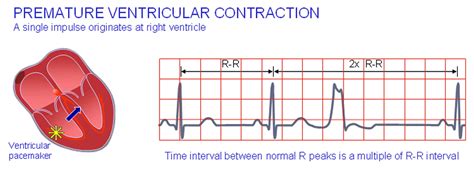 beta-blocker|Premature ventricular contractions (PVCs) .